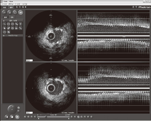 図3　IVUS画像
